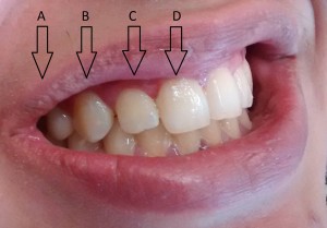 Even a temporary tooth can look remarkably natural. 