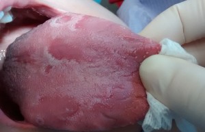 Geographic tongue
